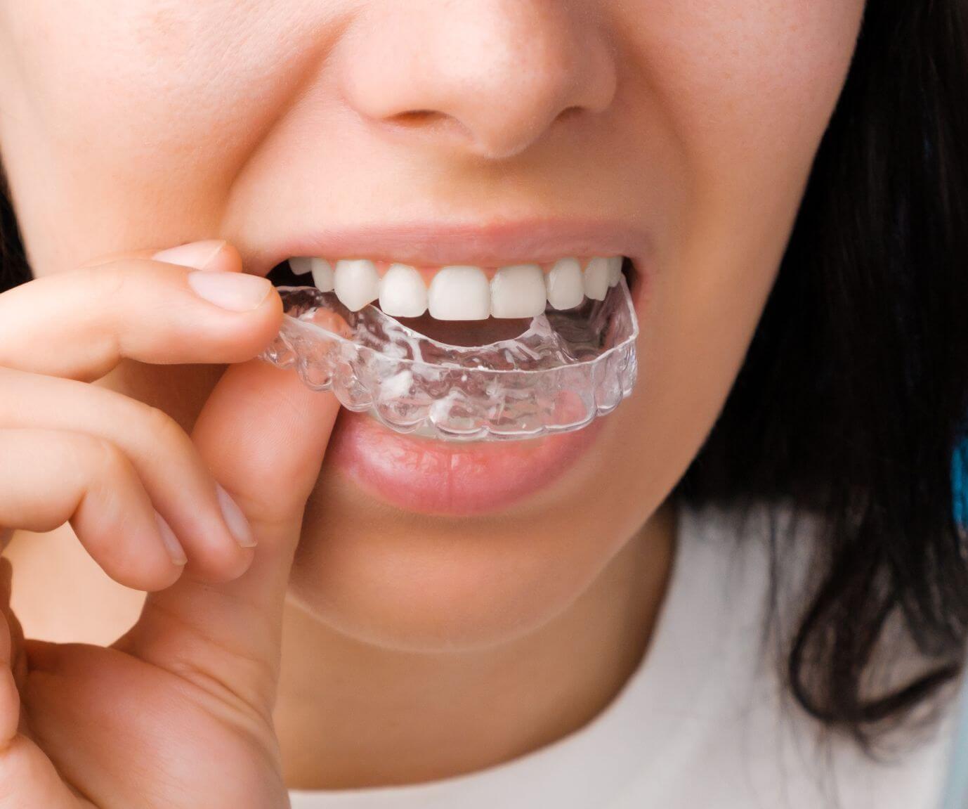 woman holding invisalign aligners to her mouth