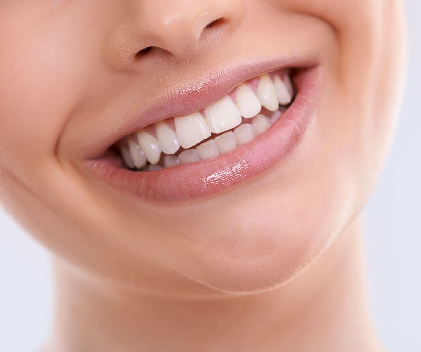 Woman smiling after teeth whitening treatment at The Care Dental Practice, Hammersmith